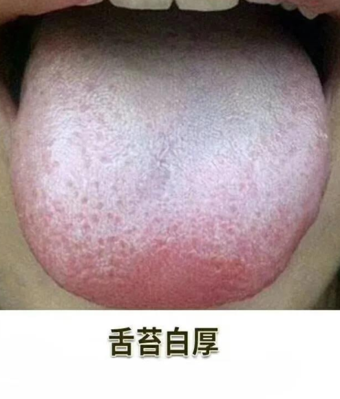 奶垢/消化不良舌苔白厚宝宝舌苔,是脾胃健康的镜子!
