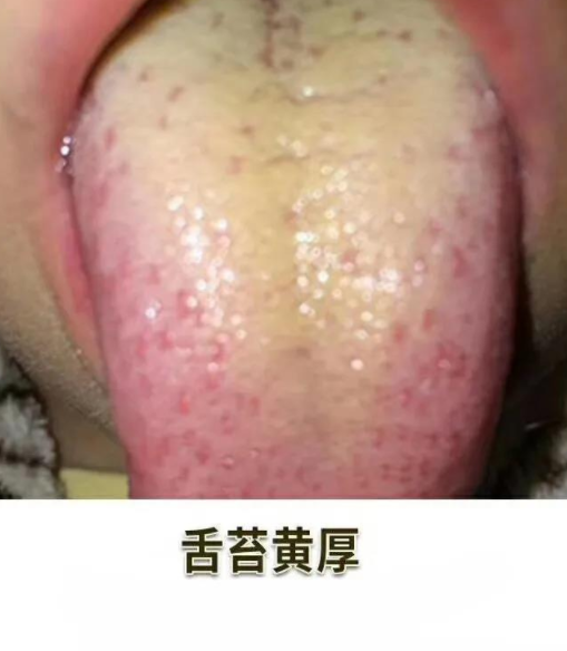宝宝舌苔附着厚厚的黄色舌垢,并伴有口臭,食欲不振,腹胀腹痛等症状,很